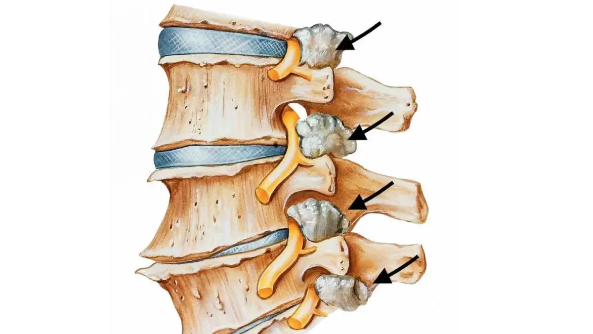 ¿Cuándo la estenosis lumbar es grave y hay que operar?
