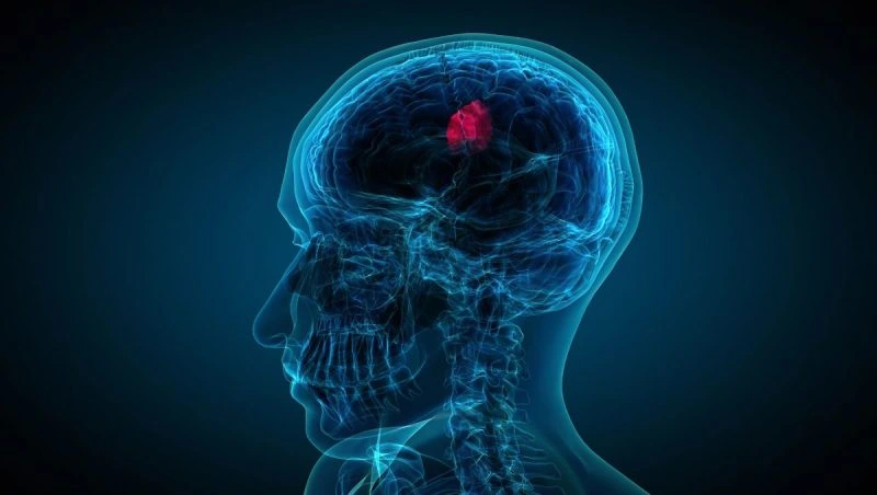 Diagnóstico y tratamiento de tumor cerebral en Barcelona