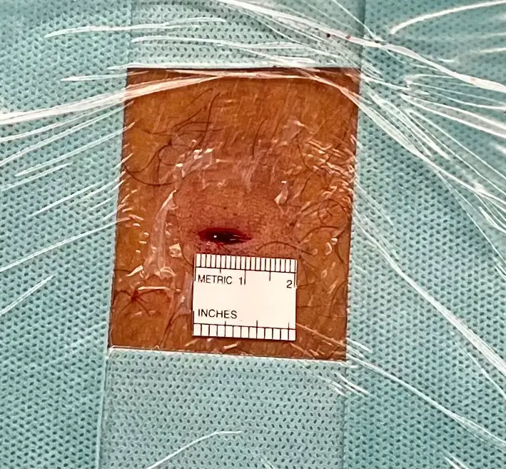 Endoscopia neuroquirúrgica: técnica Ultra MISS en Barcelona