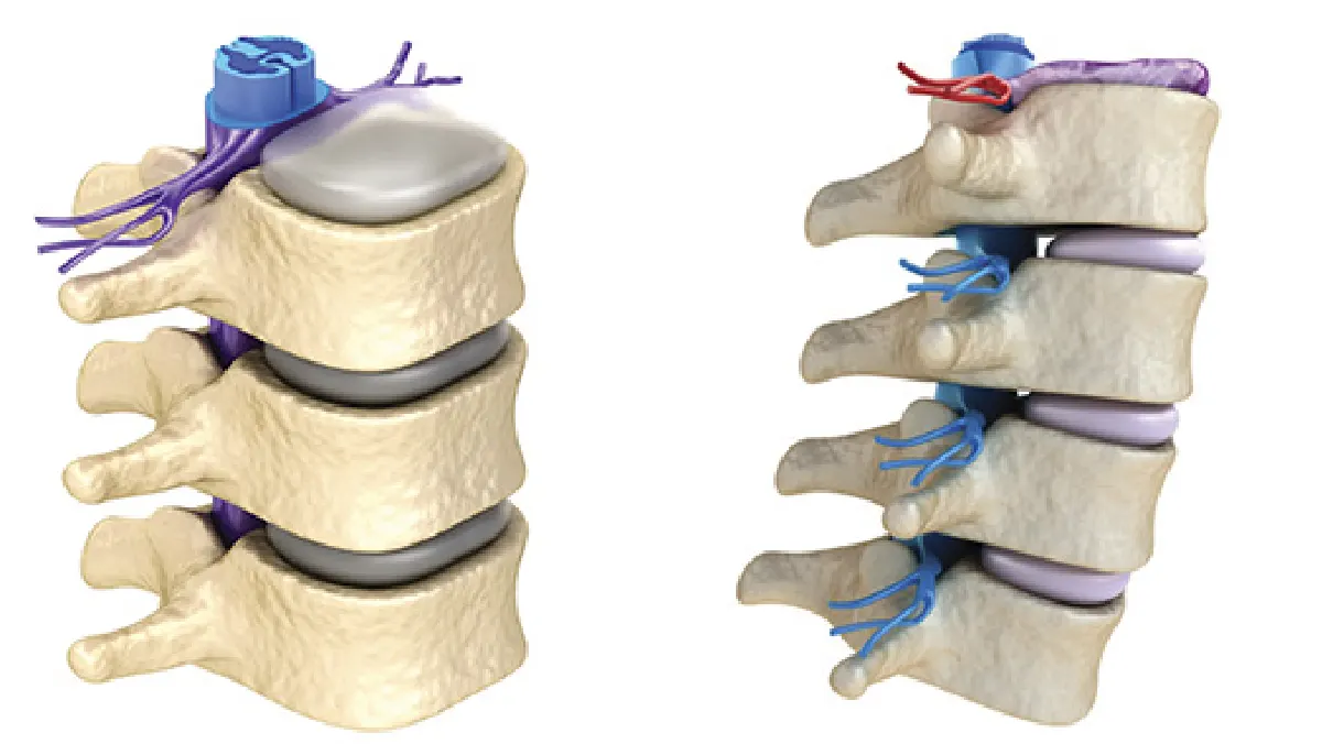 Estenosis lumbar: qué es y por qué cuesta caminar