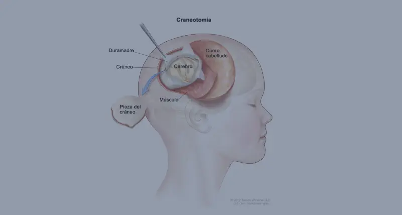 Cirugía de gliomas cerebrales en Barcelona
