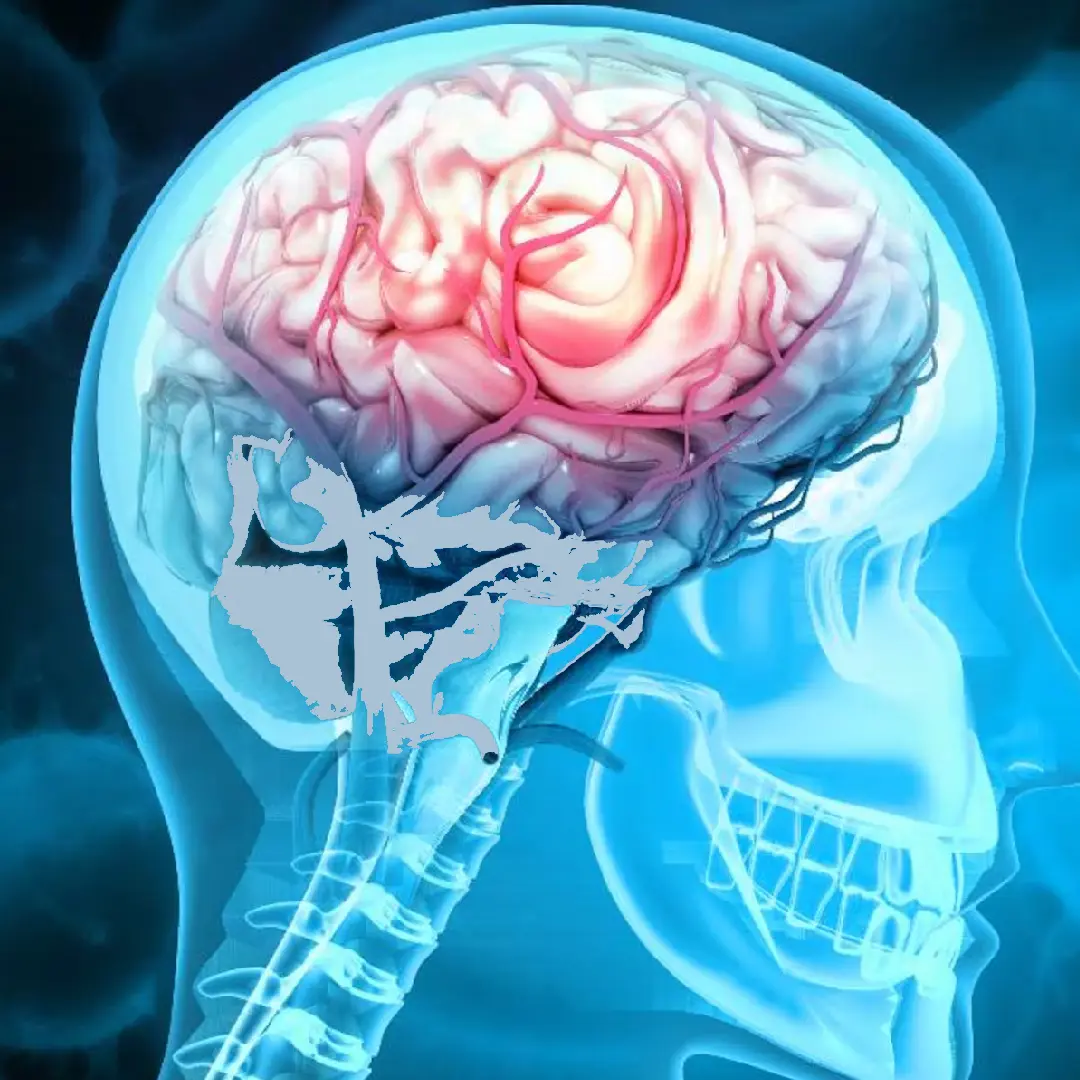 Resultados y pronóstico de la cirugía de epilepsia refractaria
