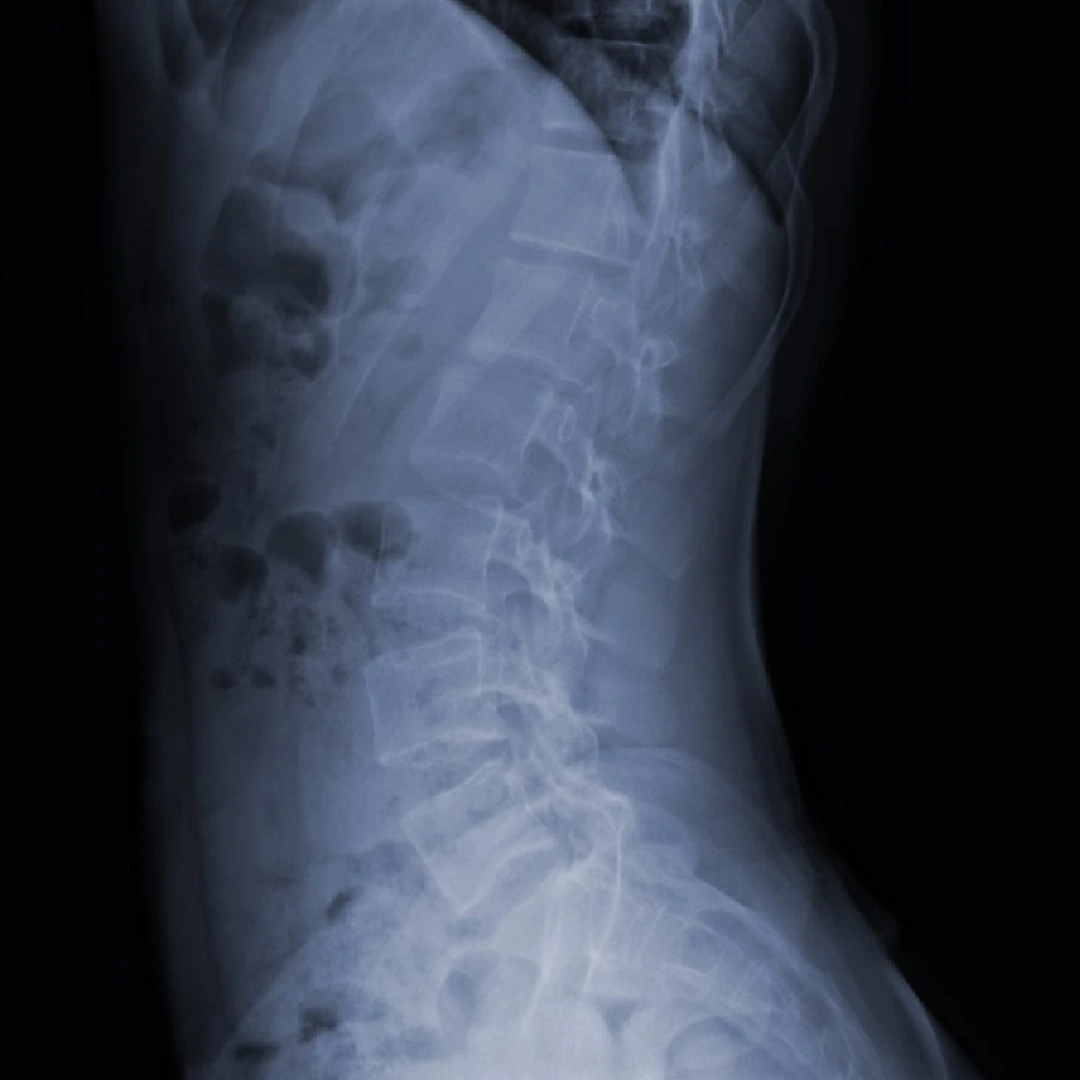 Columna vertebral — cirugía endoscópica, MIS y robótica