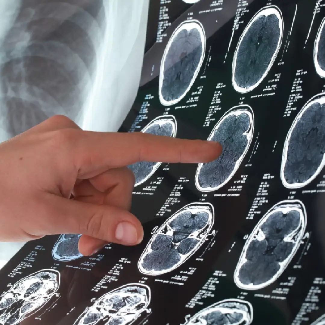 Resección microquirúrgica de meningiomas