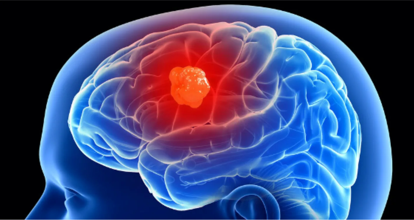 Cirugía oncológica cerebral: resección de tumores cerebrales
