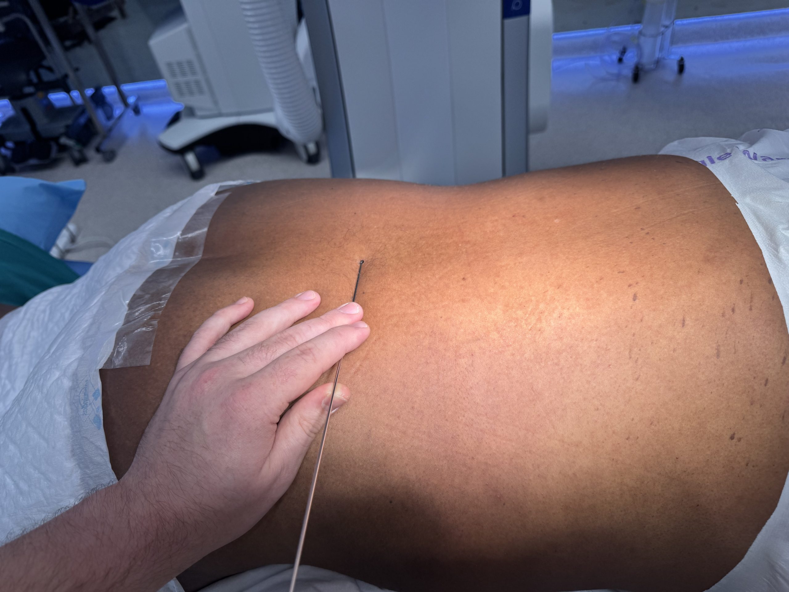 Endoscopia de Columna en Barcelona